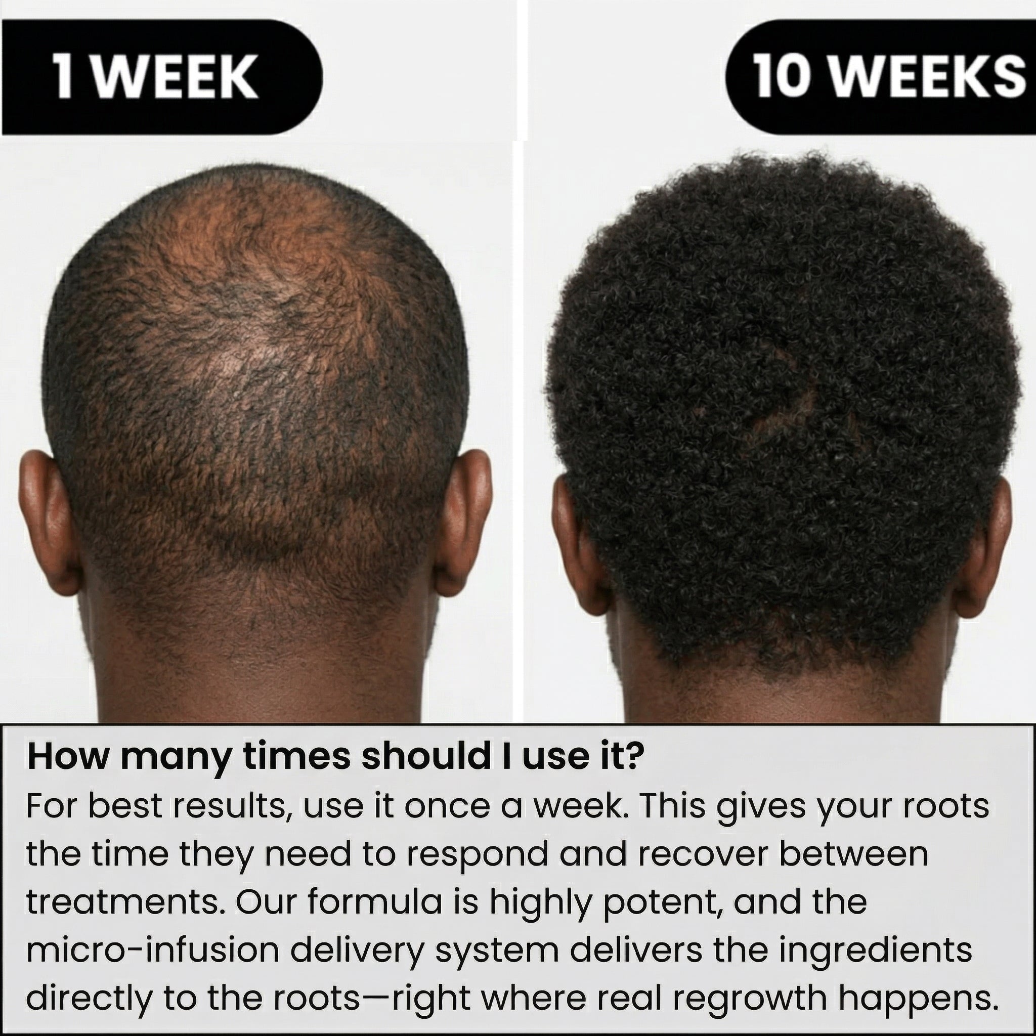 AlphaVance™ Hair Regrowth System