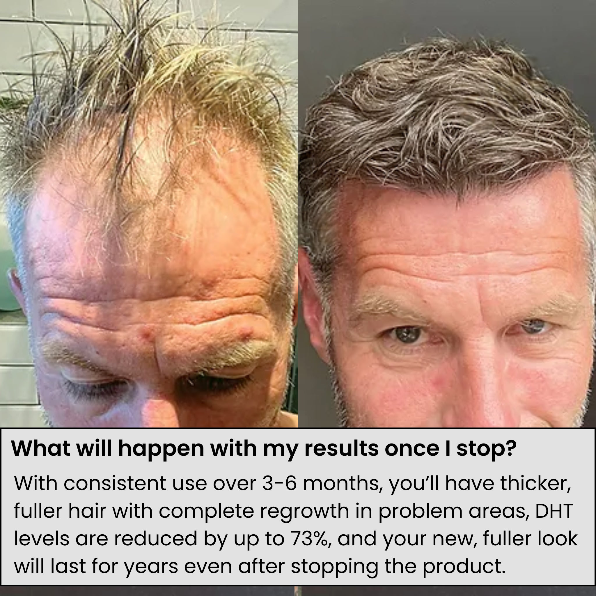 AlphaVance™ Hair Regrowth System
